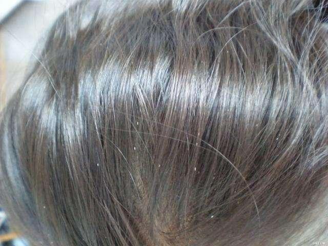 梦到头上长虱子并掐死（女儿头上长了许多虱子）