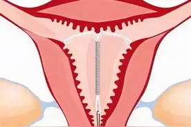 “上环”坑了一代女性？今天为它正名图片