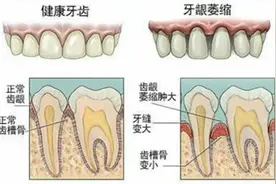 保护牙齿从预防牙龈萎缩开始！使用牙线和刷牙，真的很重要图片