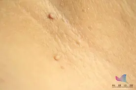 身上莫名长出的"小揪揪"，皮肤病还是HPV感染了？图片