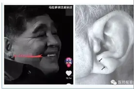 耳垂褶皱与心血管疾病有关？心血管内科医生告诉你答案图片