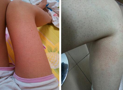 怎样去腿鸡皮肤