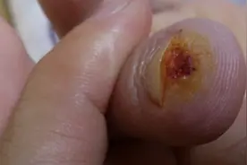 皮肤上的小肉球、肉疙瘩到底是什么？不出意外，4种可能性较大图片
