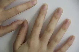 醒来后，手指肿胀得厉害，却又找不到原因，是怎么回事？图片