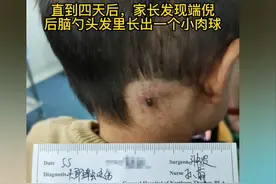 3岁孩子被蜱虫咬，妈妈的“三个果断”救了娃，医生点赞：有见识图片