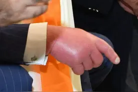 71岁查尔斯访问印度，脱下鞋袜双脚肿得像馒头，为何他手脚都红肿图片
