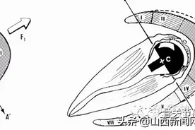 长治二院关节外科一病区成功开展反置式肩关节置换术（RSA）图片