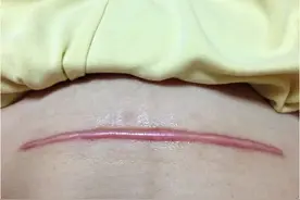 愁人！剖腹产后，肚皮上的“毛毛虫”能去掉吗？图片