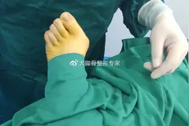 大脚骨手术体位及消毒铺巾，这是大脚骨手术流程，了解一下图片