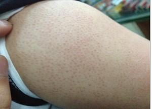 淘宝鸡皮肤药膏