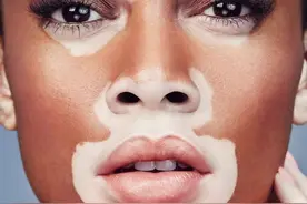 几年白斑的大山女孩 四处辗转为找回美丽图片