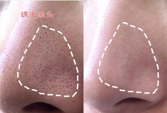 洗面奶中这2种网红护肤成分叠加使用：温和清洁+除螨杀菌＞2？