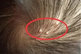 为什么头皮老是长疙瘩？或与这3种病有关图片