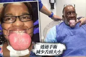 新冠后遗症有多恐怖？美国多名康复者出现“巨舌症”，场面震撼图片
