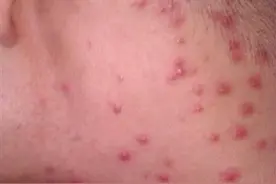 梅毒是性病吗？如何传染对人体的危害，是什么？图片