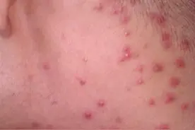 梅毒是性病吗？如何传染对人体的危害，是什么？图片
