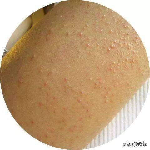 孩子怎么预防鸡皮肤