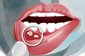 小李经常口腔溃疡，一检查竟是癌症，到底是什么情况？图片