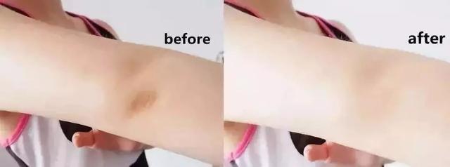 鸡皮肤治疗神器