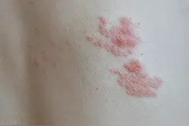 带状疱疹发作，从潜伏期到恢复期，要经历几个阶段？第4个最痛苦图片