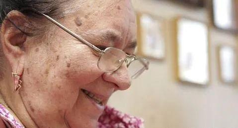 怎样去除角化癍