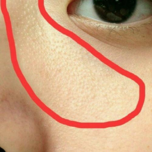 去除女孩汗管瘤眼睛周围汗管瘤怎么去除