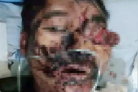 男子上山拾柴火，被黑熊咬伤半边脸，左眼球被摘除视频封面