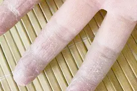 手指脱皮的原因是什么？我们一起来看看吧！视频封面