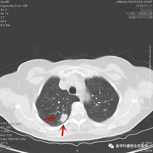 叶建明谈结节：检查发现肺实性结节怎么办？个人版实用指南