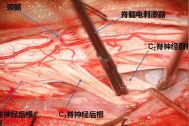 西部首例！西安交大一附院神经外科完成颈段选择性脊神经后根部分切断术治疗偏瘫图片