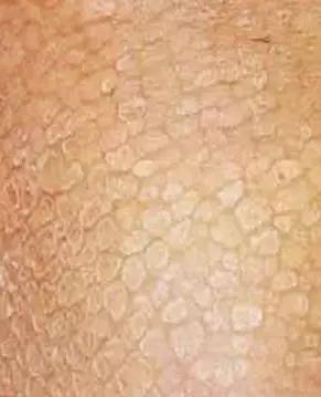 鱼鳞病流汗吗 鱼鳞病流汗吗