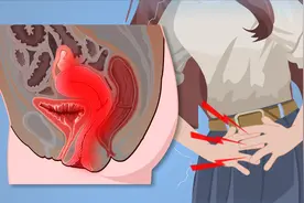 啪后腹痛不在意？白带多没事？妇科炎症别大意！这症状小心盆腔炎图片
