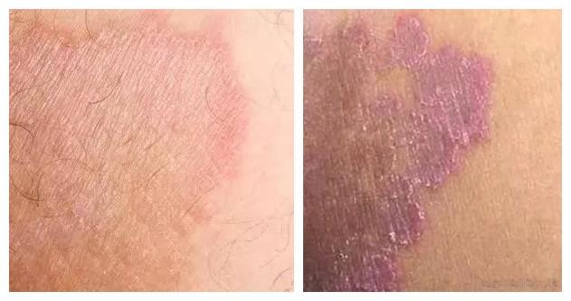 进入夏天以来,小亮的大腿内侧,腹股沟,臀部等"不见天日"的潮湿地带,又