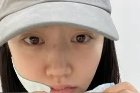 景甜拔智齿后首露面，右脸肿成包子气色憔悴，脱妆后鼻梁疤痕明显图片