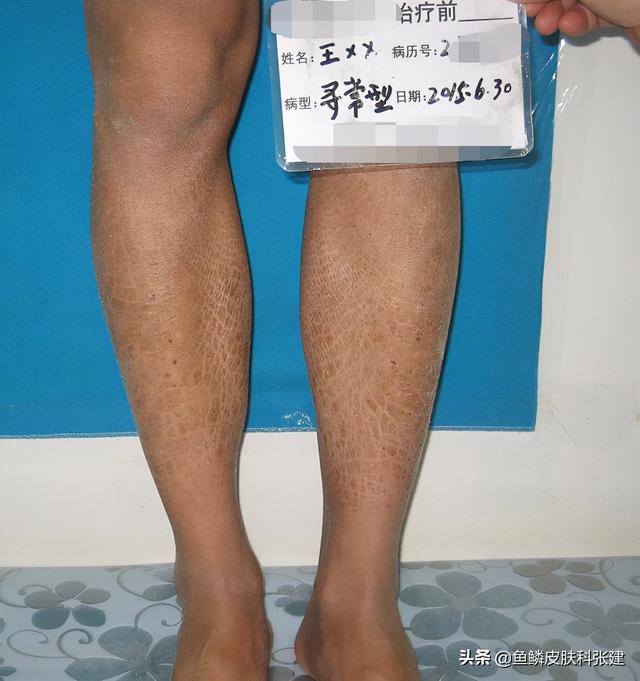 鱼鳞病护理和正常人一样