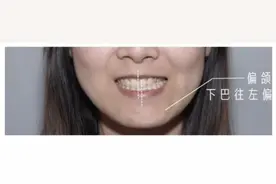 牙齿畸形，凸嘴该如何矫正？#雅悦齿科#图片
