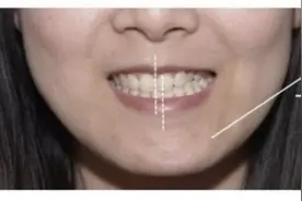 牙齿畸形，凸嘴该如何矫正？#雅悦齿科#图片