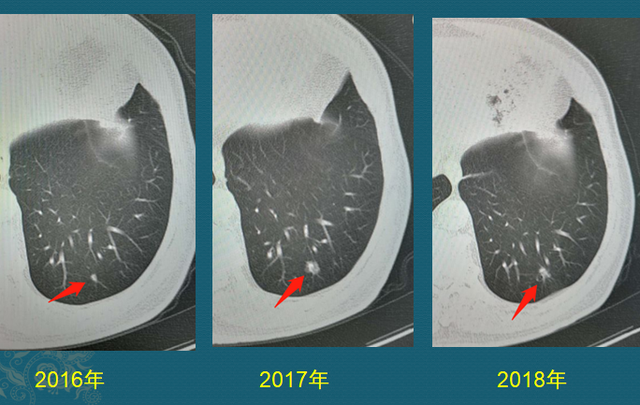 肺癌病理非角化型鳞癌