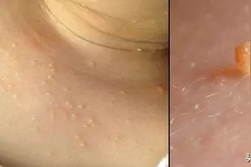 重视：脖子上的小肉粒到底是什么？暴露出你很多健康问题，快自查图片