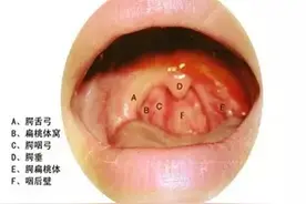 慢性咽炎怎样才能除根？图片