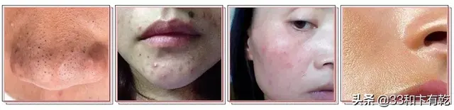 火爆INS的芝士皂，洗脸就像敷面膜，痘痘，黑头，螨虫全都消失了