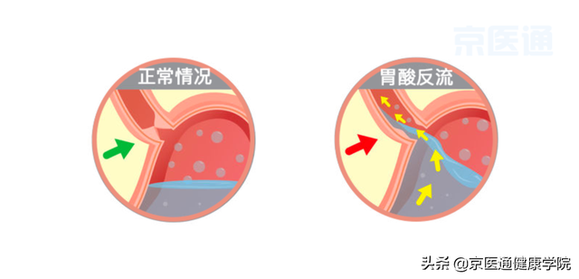 烧心是怎么回事？医生教你6个方法缓解