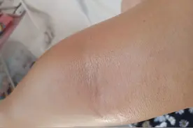 感冒还没好，手臂 突然又起红点点，怎么了呢图片