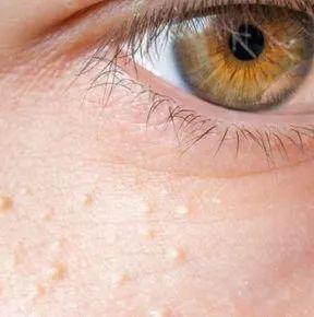 皮肤晒伤后像鸡皮多年