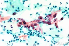 一针10万！只要注射一次，能预防12种癌的癌症疫苗，靠谱吗？图片