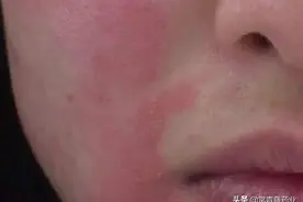 面部皮炎应该怎么治疗预防，激素药膏可以抹在脸上吗？图片