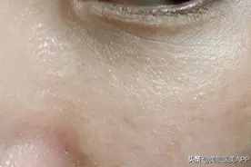 如何选到最适合自己的水光针？最全干货来了图片
