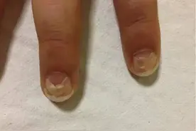 宝宝突然出现指甲脱落是怎么回事？图片