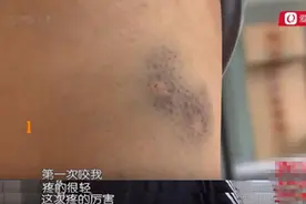 女子俩月被狗咬两次，两只狗竟然是同一主人！狗主人：按倒霉处理图片