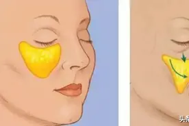 苹果肌松、垮、垂，是做填充、线雕提升还是拉皮手术好？图片